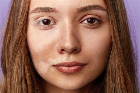 Skin Pigmentation Disorders: Types, Symptoms, and More