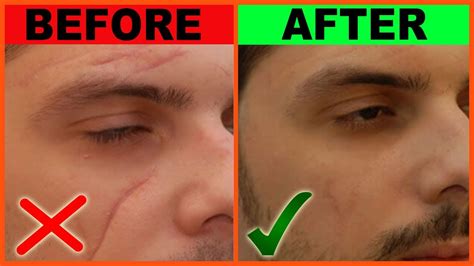 Diy Scar Removal