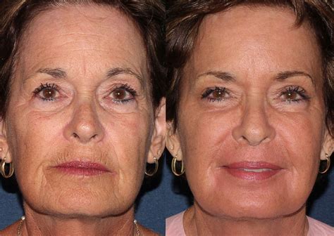 Lasers for Deep Wrinkles by San Diego Dermatologists