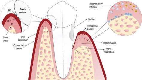 Pocket Reduction Surgery – Loop Perio Chicago Periodontists & Implants