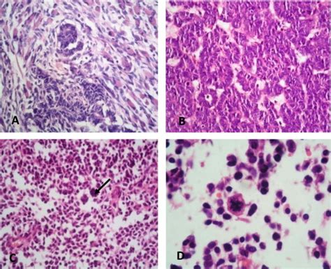 (A) Wilms tumor with favorable histology. (B) Wilms tumor with nuclear... | Download Scientific ...