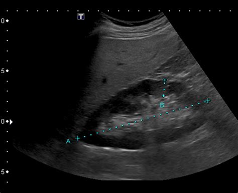 Buscar a tientas discreción Monótono renal artery duplex ultrasound ...