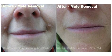 Mole Removal Before & After | Beauty-Full Spa