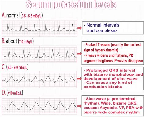 Hyperkalemia And Ekg