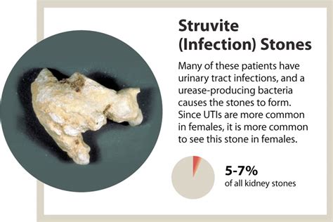 Kidney stones - a marker of overall kidney health - News | UAB