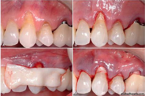 Mucogingival surgery pptx - د.هندرين - Muhadharaty