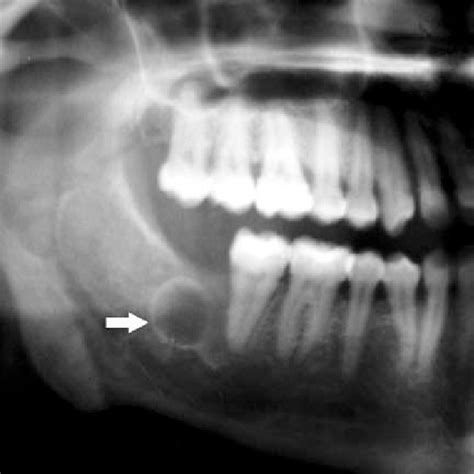 Periapical Cyst Radiograph