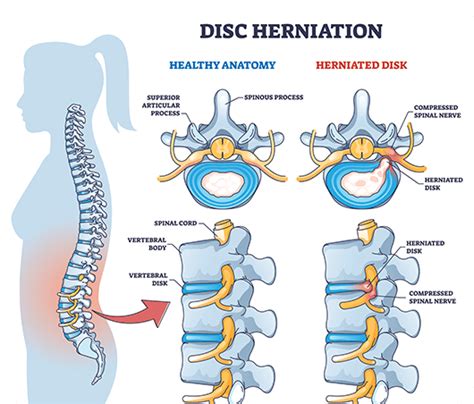 Slipped Disc | Symptoms, Causes and Treatment | ANSSI Wellness