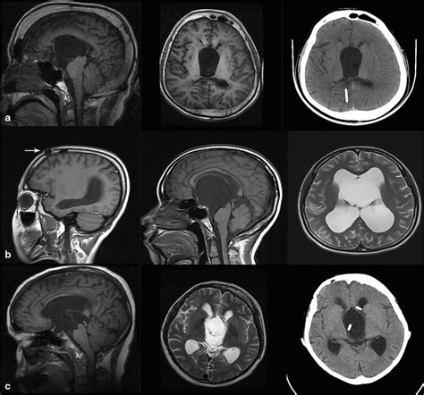 a–c Preoperative MRI and CT scans of the patients with a prior VP shunt ...