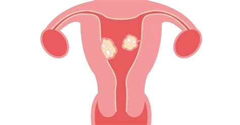 Fibroids Size: What Do I Need to Know?