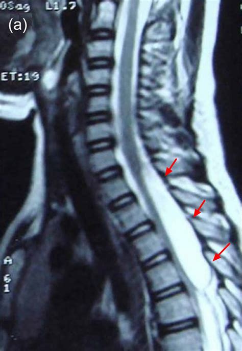 Arachnoid cyst causes, symptoms, diagnosis, prognosis and treatment