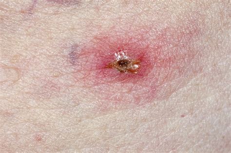 Infected tick bite - Stock Image - C016/7236 - Science Photo Library