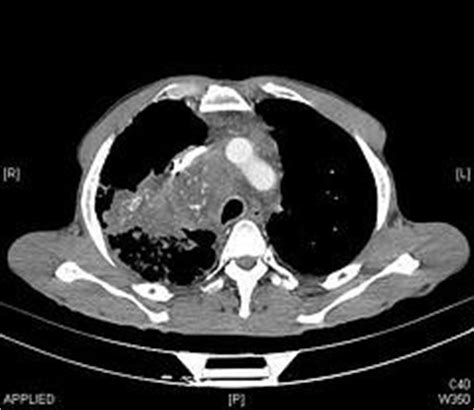 Pneumonia symptoms and back pain | General center | SteadyHealth.com