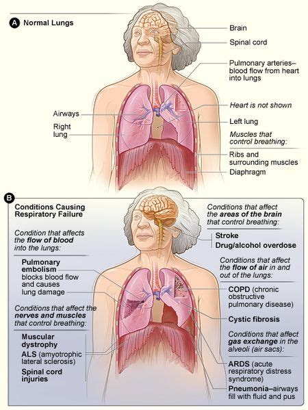 Impressive Tips About How To Cure Hypoxia - Policebaby25