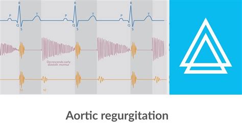 Wiggers Diagram Aortic Regurgitation