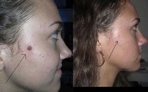 Mole Removal Before and After - Mole Removal