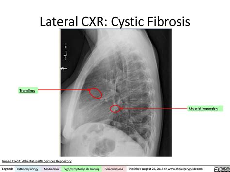 Lateral Chest X-Ray | Calgary Guide