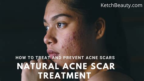 Natural acne scar treatment | How to treat and prevent acne scars – KetchBeauty