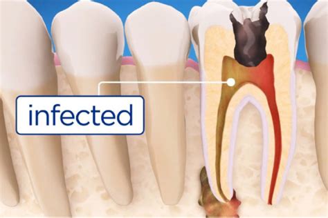 Before, During & After a Root Canal | High Point Dentistry