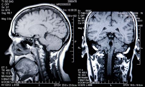 Mri Images Of The Brain