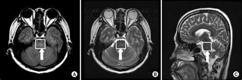 Brain magnetic resonance imaging (MRI) scan at the level of the pons ...