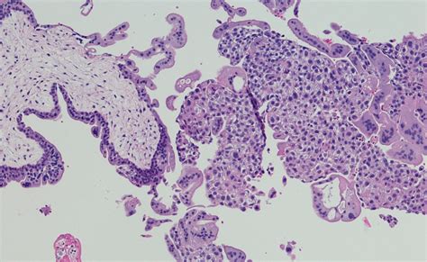 Trophoblastic Neoplasia: Symptoms, Diagnosis Approach