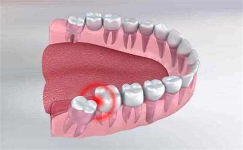 Effective Natural Cures To Soothe Wisdom Toothache - Odyssey Dental of Summerfield