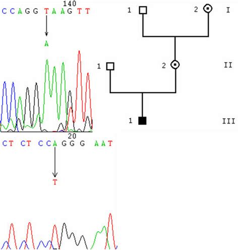 splice site mutations. 5A: chromatogram of the 547+2T->A mutation, from... | Download Scientific ...