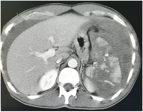 Abdominal CT scan showing splenic rupture with hemoperitoneum. | Download Scientific Diagram