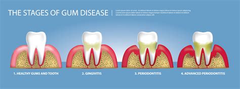 Periodontal Disease Stages