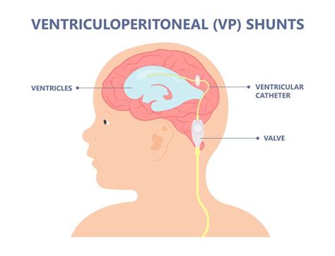 Ventriculoperitoneal Shunt - Hart Garner, MD - Minnesota Spinal ...