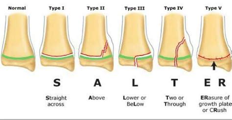 PEDIATRIC EPIPHISIAL FRACTURE (SALTER-HARRIS) CLASSIFICATION Radiology ...