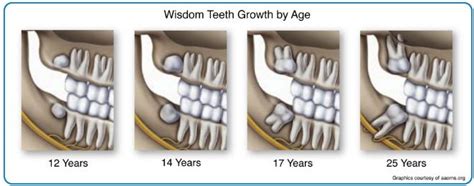 Wisdom Teeth