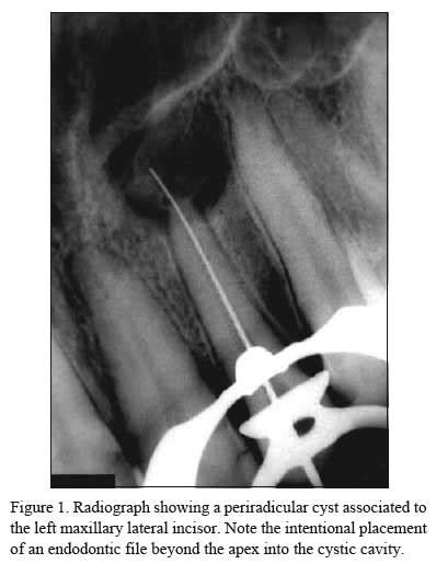 SciELO - Brasil - Periapical cyst repair after nonsurgical endodontic therapy: case report ...