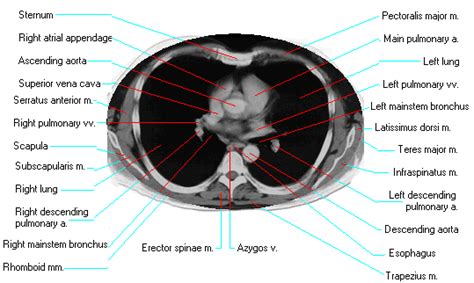 Ct Thorax Anatomy - Anatomical Charts & Posters