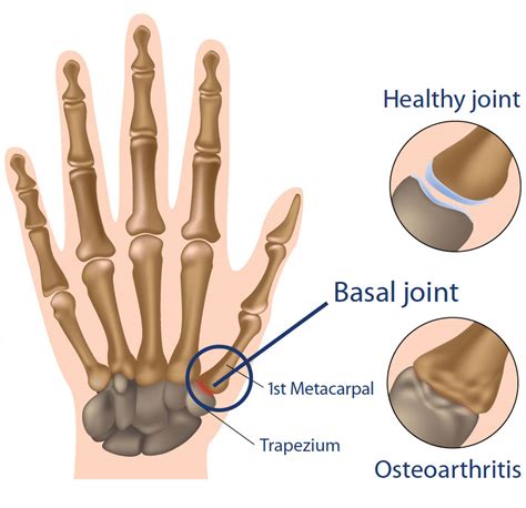 CMC Arthritis | BoulderCentre for Orthopedics & Spine