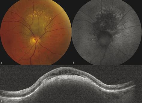 Choroidal Nevus | Ento Key