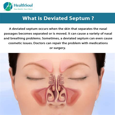 Deviated Nasal Septum: Causes and Treatment – Healthsoul