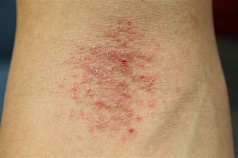 ReshapeLife: Eczema: The Itch That Keeps On Itching