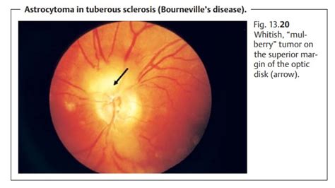 Intraocular Optic Nerve Tumors