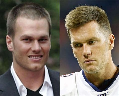 General 6 tom brady hair transplant best - BSS news