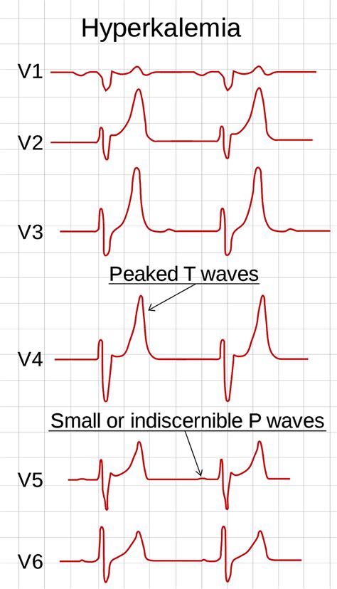 ECG afwijkingen bij Hypo en Hyperkaliemie// - Acute Zorg Blog