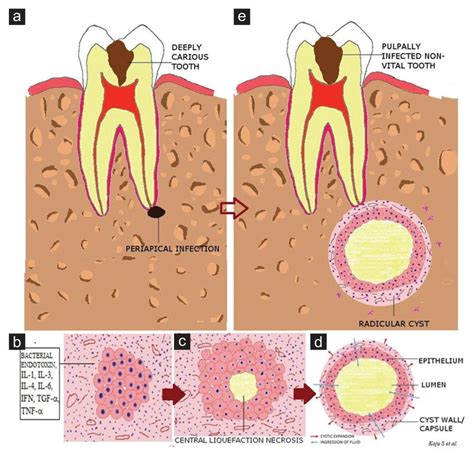 Histology Periapical Cyst