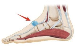 GANGLION CYST | Foot Medical Centre | Newmarket Foot Specialist | Newmarket Podiatrist