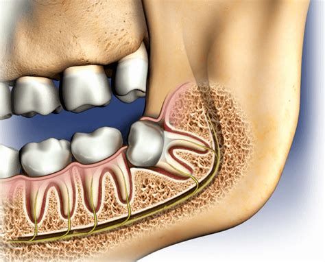 Removing wisdom teeth | healthdirect