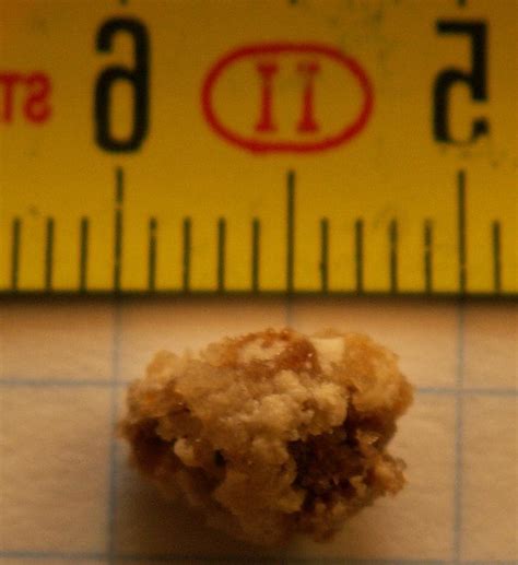 Uric acid kidney stone photos