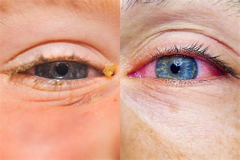 Allergies or Pink Eye: Here's How to Tell the Difference | Reader's Digest