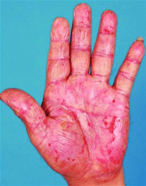 Patient with hand eczema before initiation of ultraviolet-A1 phototherapy | Download Scientific ...