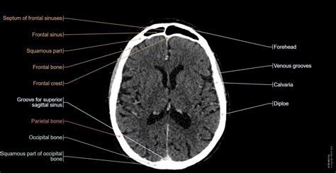 Normal Brain Ct Scan Labeled