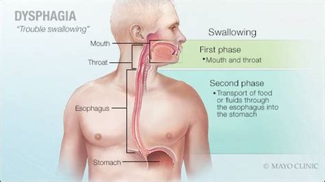 Mayo Clinic Q and A: Dysphagia is a common concern with several possible explanations - Mayo ...